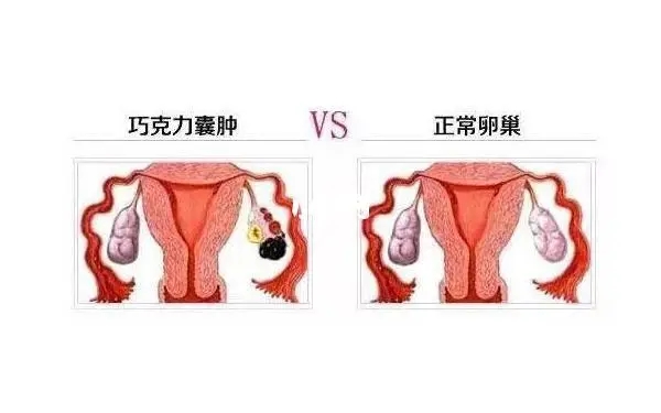 发现有巧克力囊肿应该怎么办?